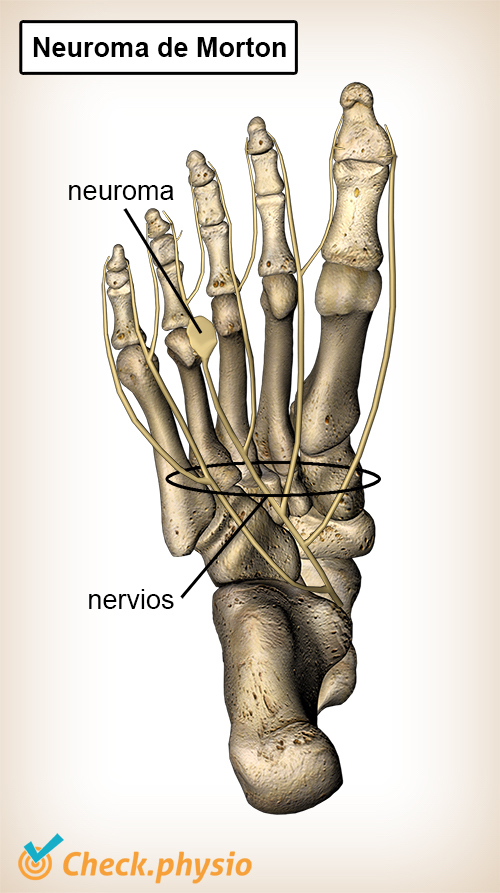 pie neuroma Morton
